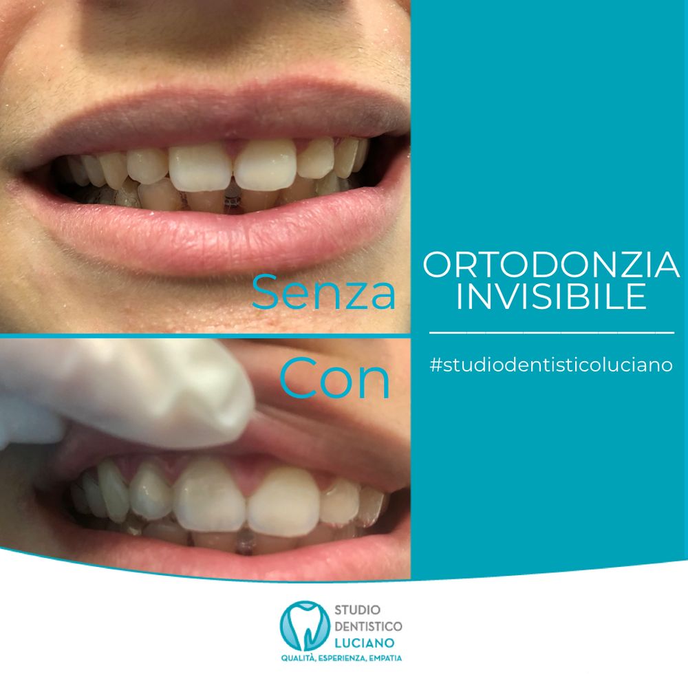 ortodonzia-invisibile-e-tradizionale (2)