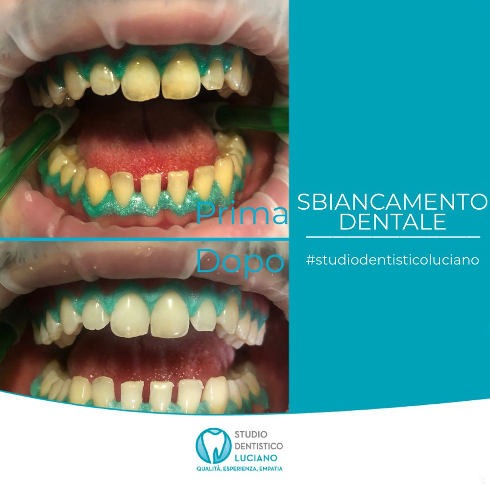 sbiancamento-igiene (2)