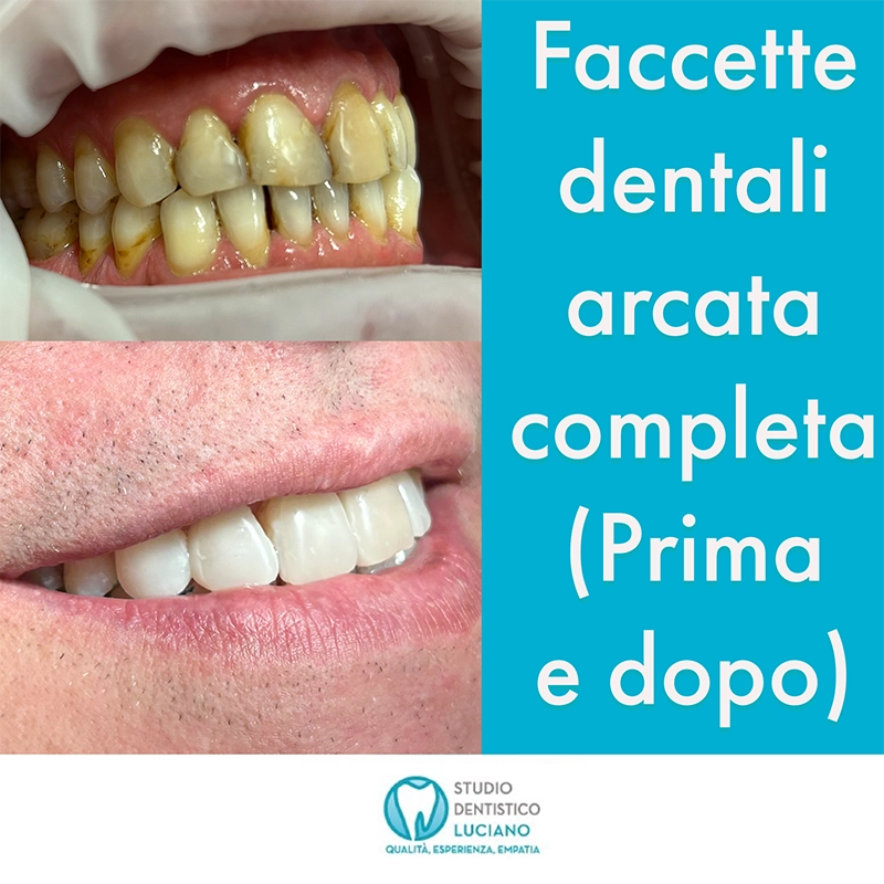 prima-dopo-faccette